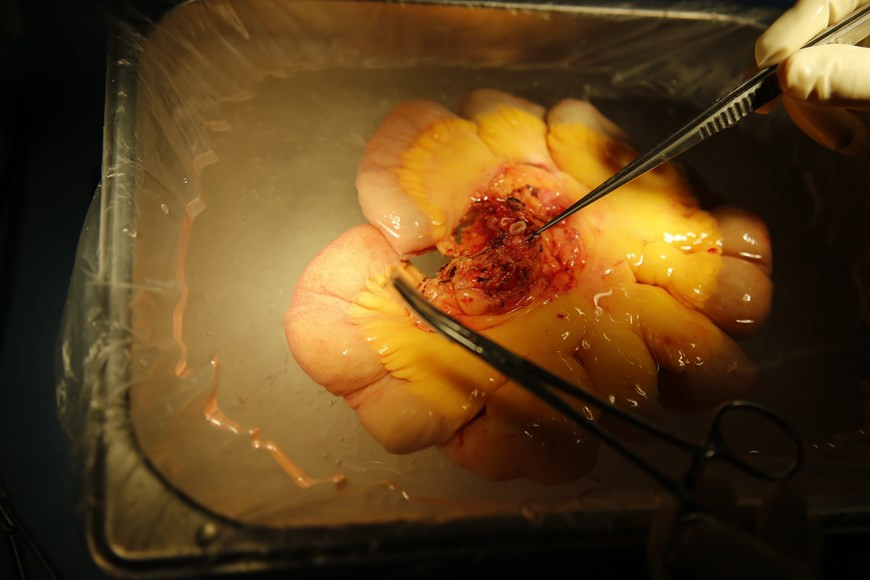 Врач Куйет сказал, что самая большая трудность при трансплантации кишечника - это соединение артерий и вен для питания пересаженного органа. По его словам, существует более высокий риск инфицирования и отторжения органов, чем при других трансплантатах, поэтому уход за двумя пациентами после операции будет сложной задачей. Военные врачи и другие эксперты определили, что трансплантация кишечника будет единственной надеждой для двух пациентов. По его словам, что их кишечник полностью потерял пищеварительную функцию. “Если им не сделают трансплантацию кишечника, они столкнутся с высоким риском осложнений, связанных с питанием вен, таких как инфекция, повреждение печени, истощение и смерть в любое время” добавил врач Куйет. По его словам, трансплантат восстановит пищеварительную функцию, и пациенты смогут нормально есть и пить. (Фото: Vietnam+)